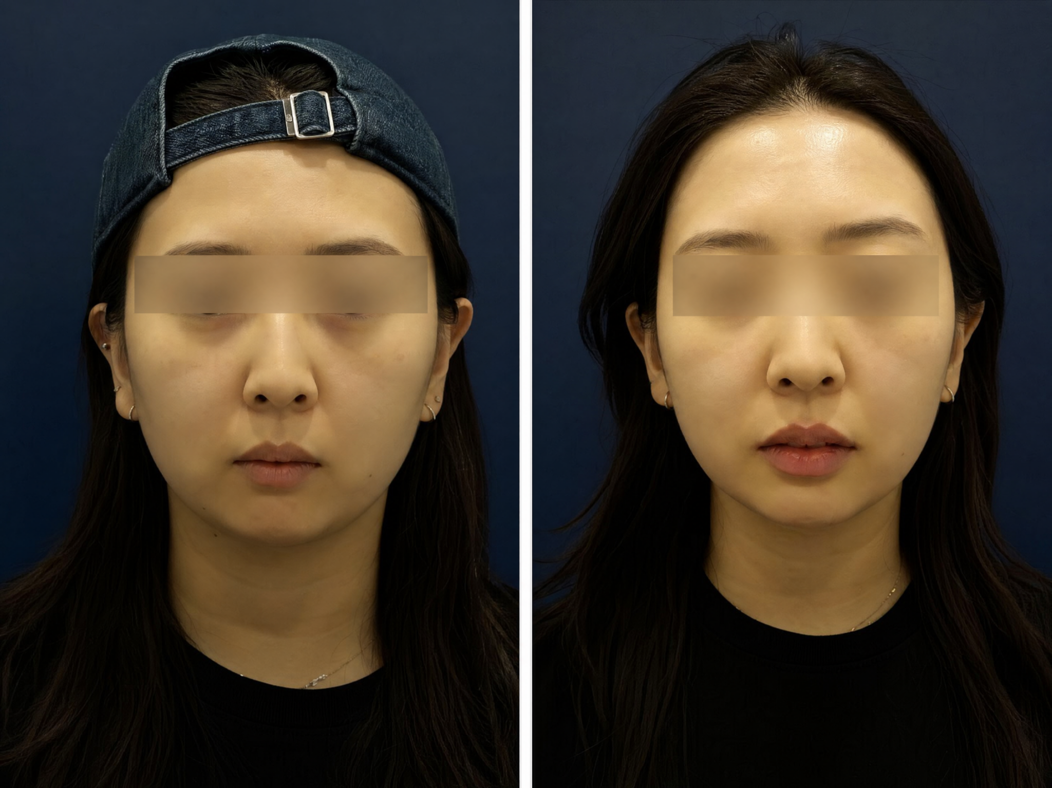 Botox Korea — Price, Jaw Slimming & Best Clinic in Seoul Before After