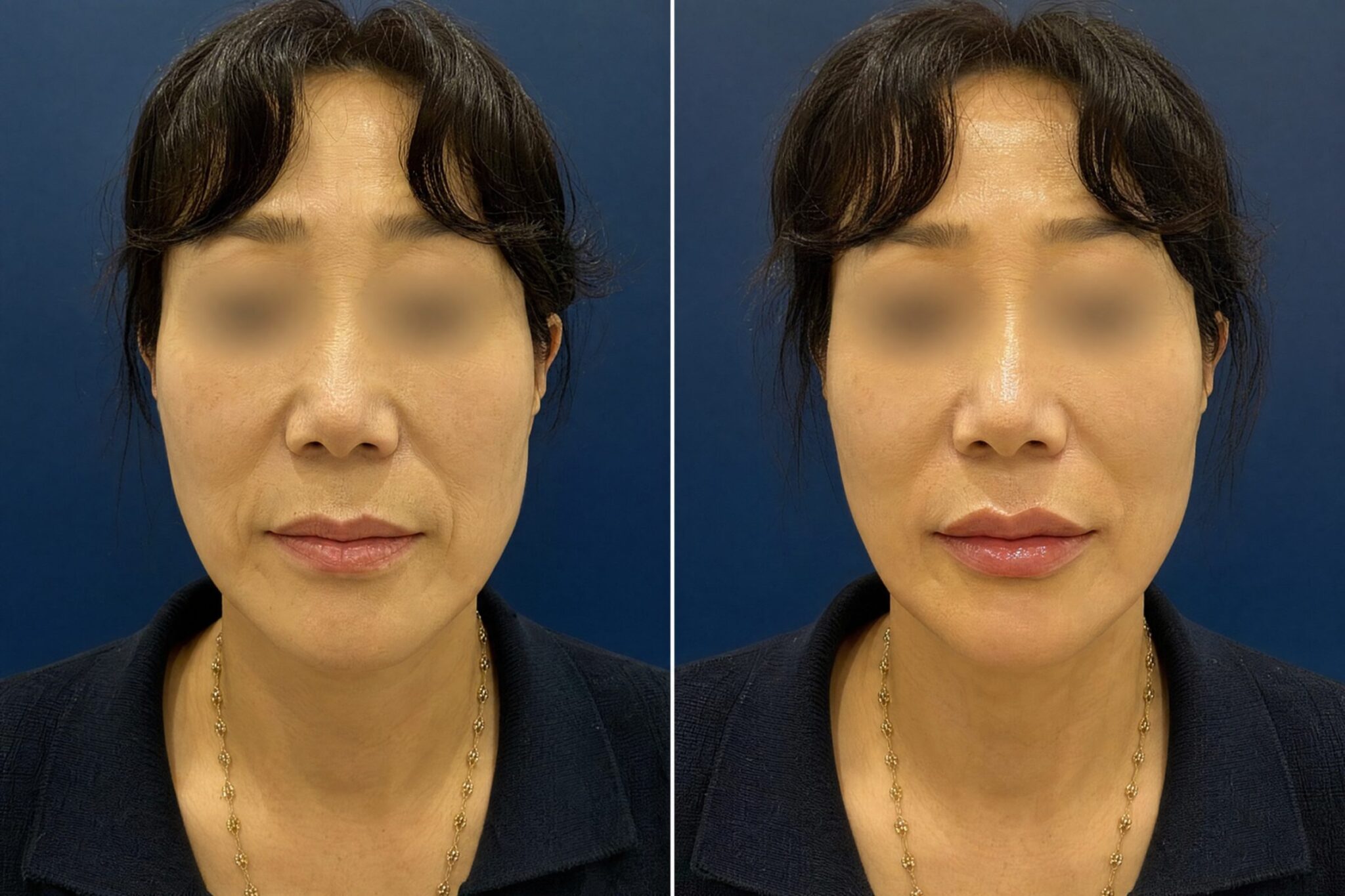 Dermal Filler Korea — Cost, Before & After, Best Clinic Seoul Before After