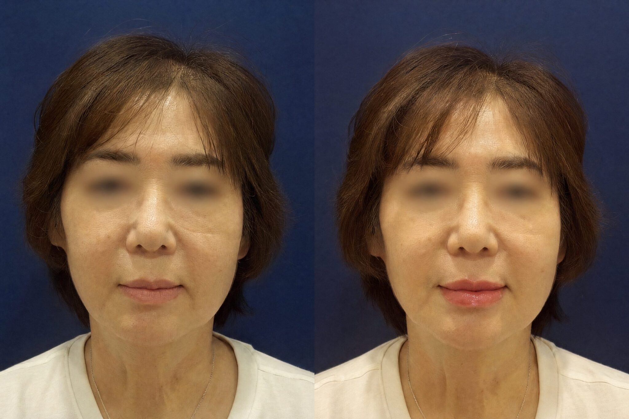 Thermage FLX Korea Before After