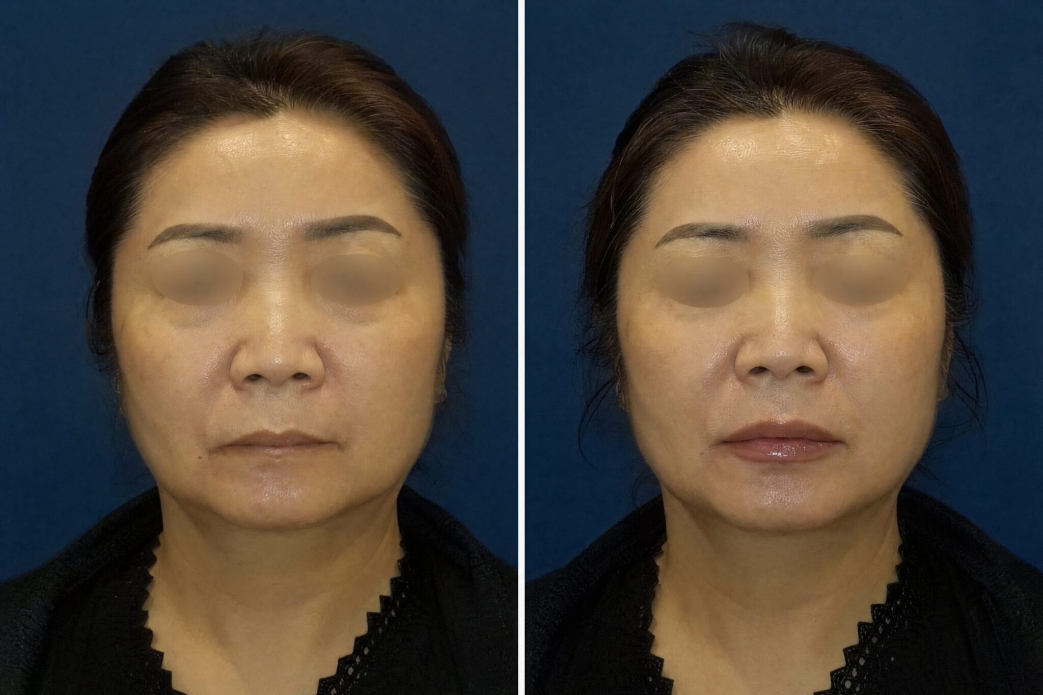 HIFU Korea — Cost, Before & After, Best Clinic in Seoul Before After