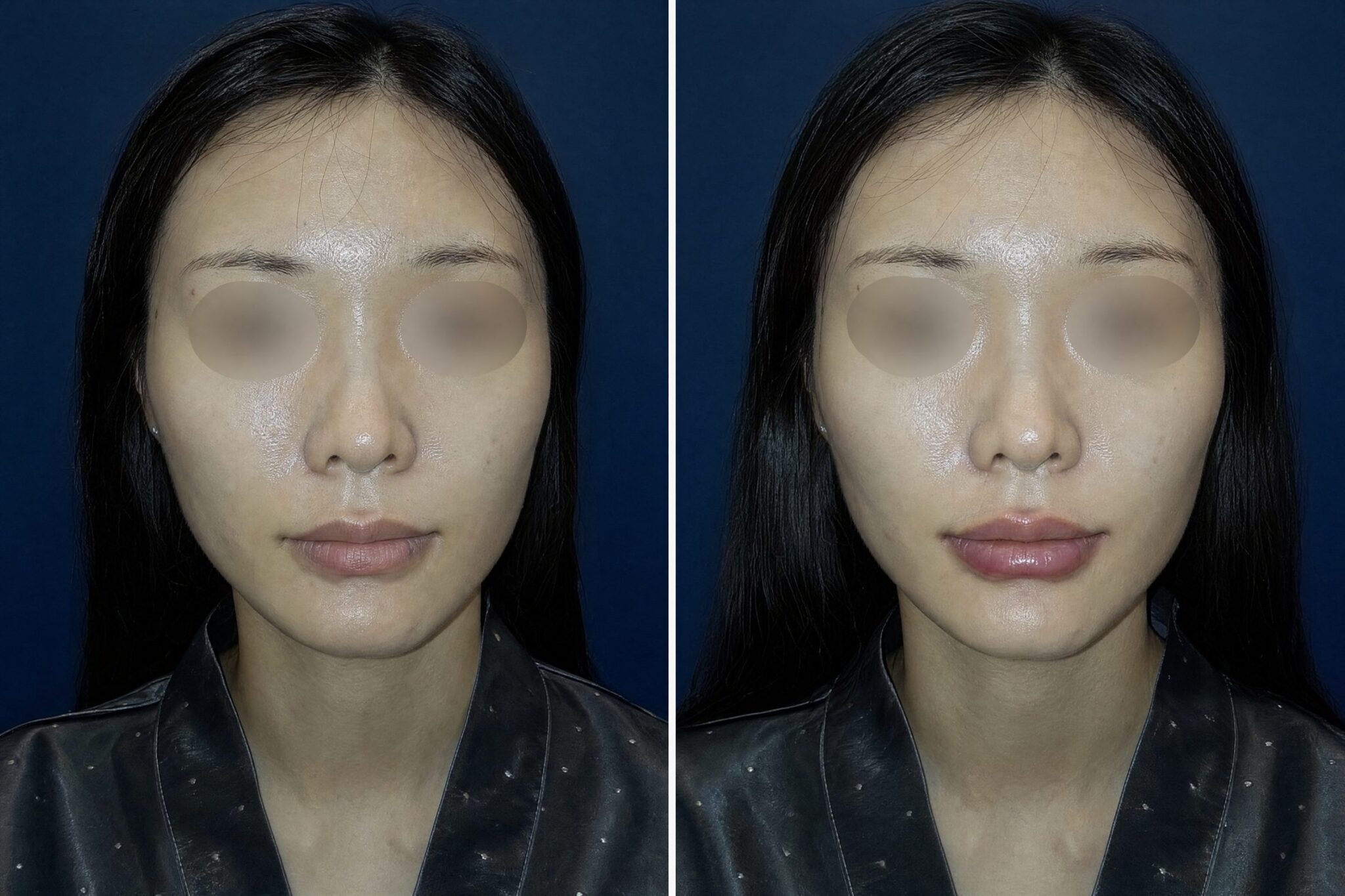 HIFU Korea — Cost, Before & After, Best Clinic in Seoul Before After