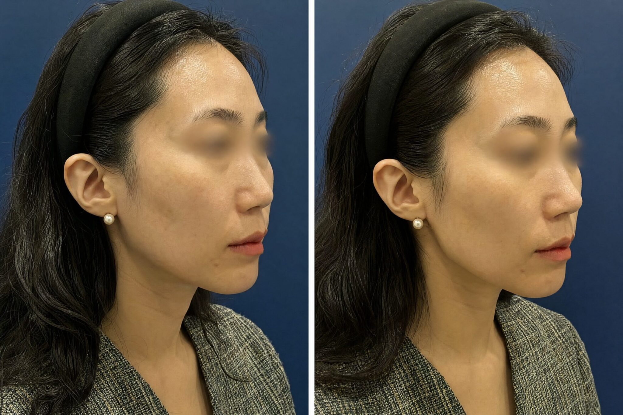 HIFU Korea — Cost, Before & After, Best Clinic in Seoul Before After