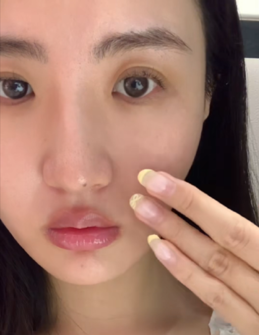 Patient face showing skin texture before ONDA treatment