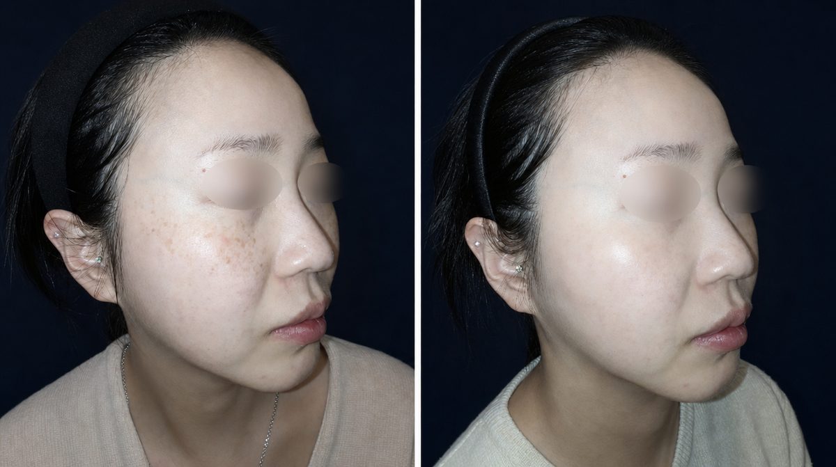 Dual Toning + Spot Laser before and after - DR.BAQUO Seoul