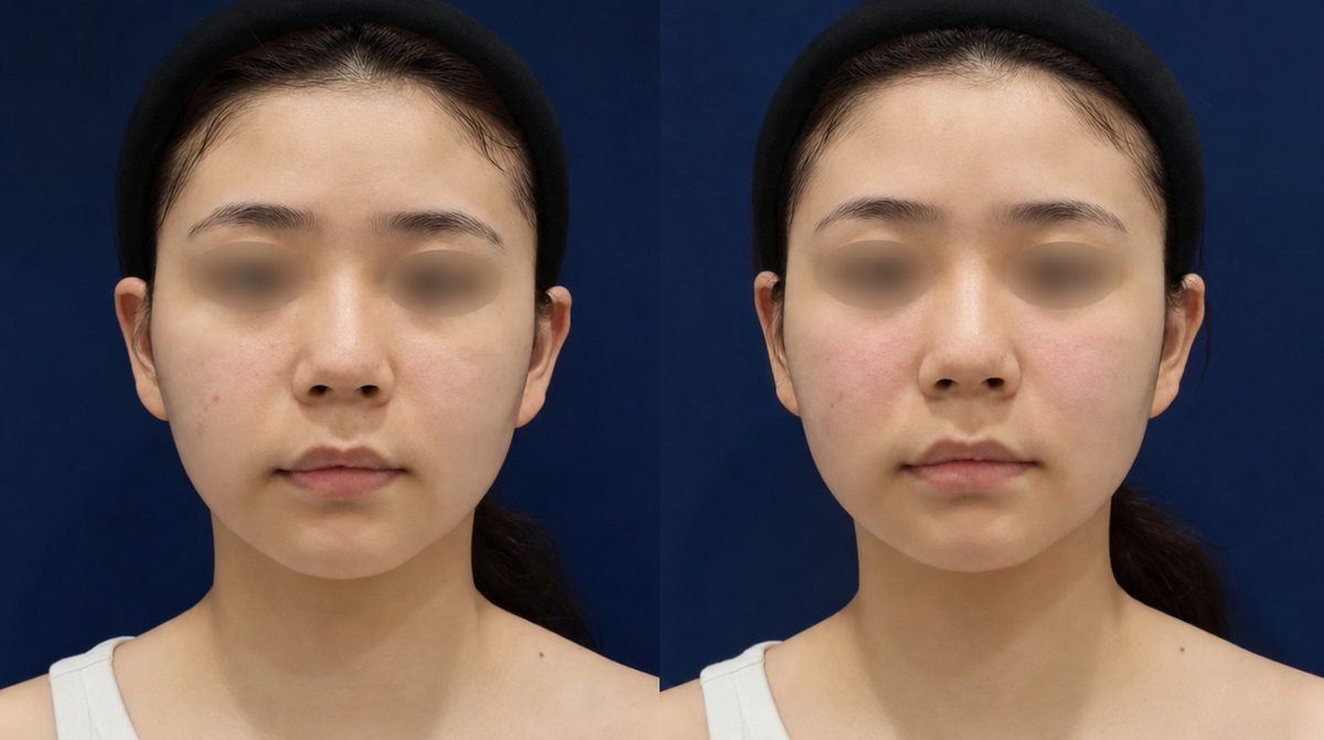 Nasolabial Fold Filler before and after - DR.BAQUO Seoul