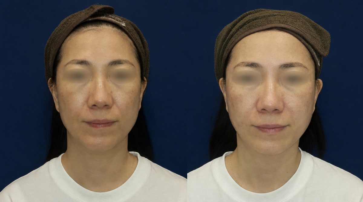 Nasolabial Fold + Thread Lifting before and after - DR.BAQUO Seoul