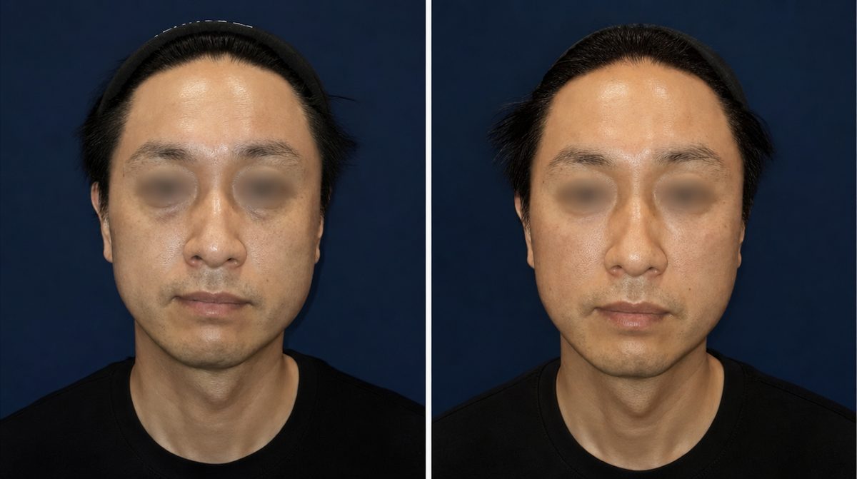 Under-eye HILO WAVE + Juvederm before and after - DR.BAQUO Seoul