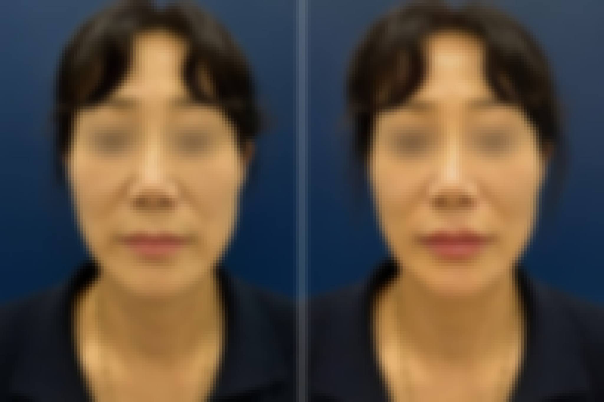 Dermal Filler Korea — Cost, Before & After, Best Clinic Seoul Before After