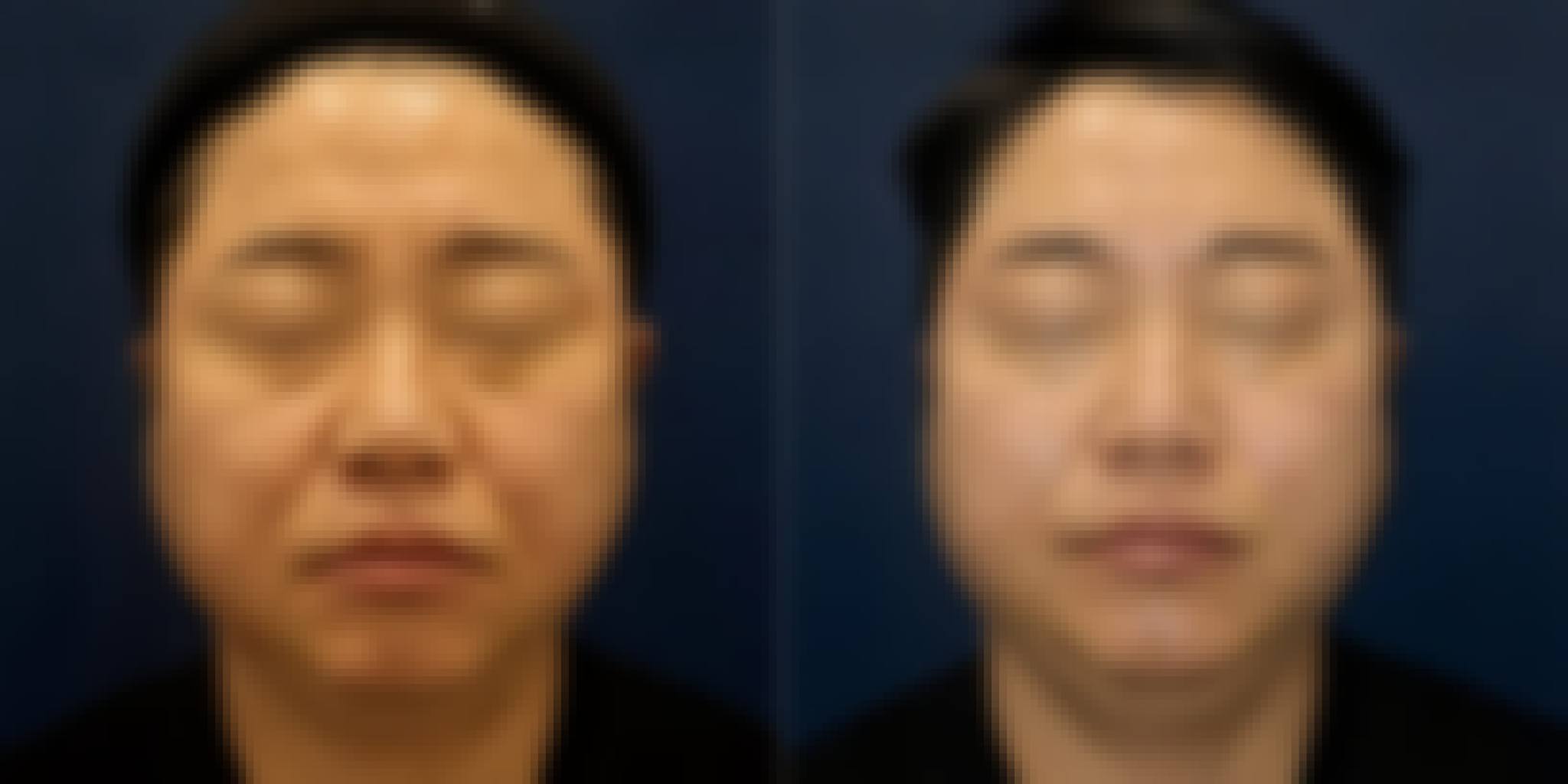 Dermal Filler Korea — Cost, Before & After, Best Clinic Seoul Before After