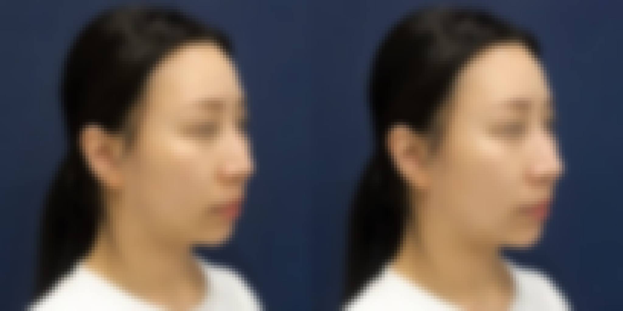 Dermal Filler Korea — Cost, Before & After, Best Clinic Seoul Before After