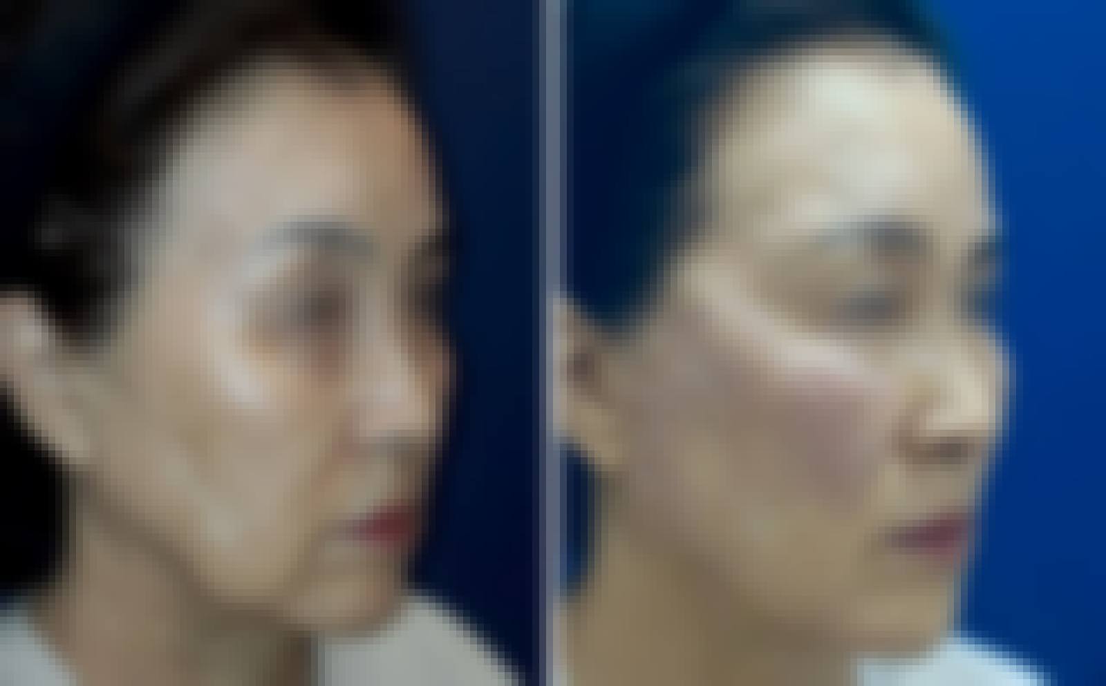 Marionette Line Thread Lifting before and after - DR.BAQUO Seoul