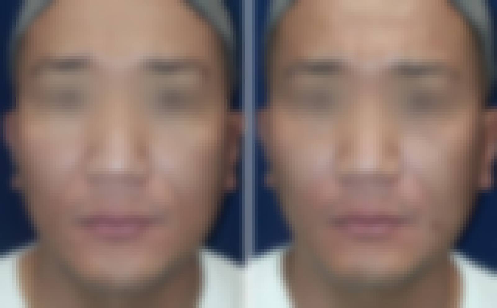 Juvelook Volume Nasolabial Fold before and after - DR.BAQUO Seoul