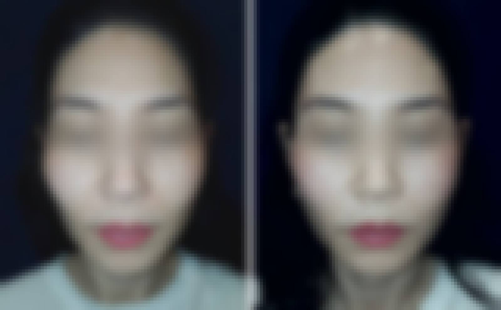DR.BAQUO首爾 Gouri 太陽穴 術前術後